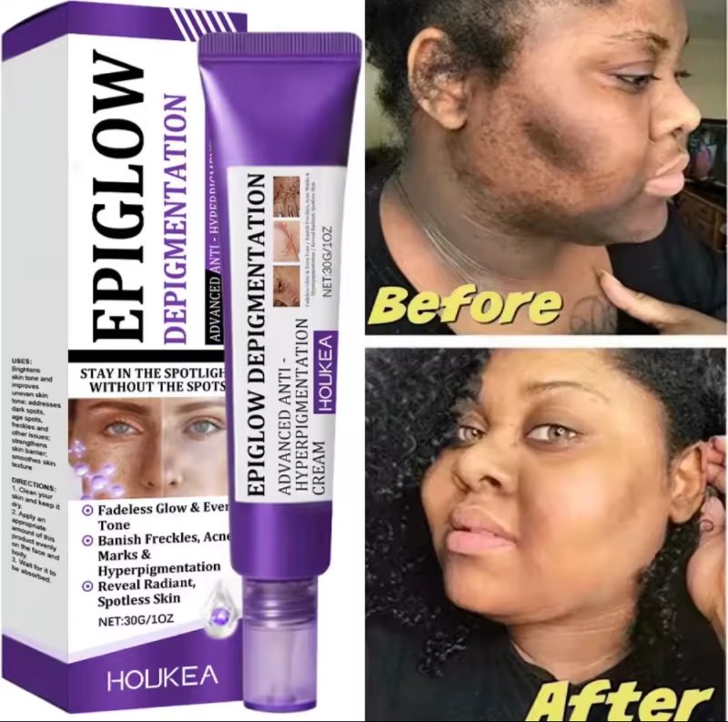 Crème éclaircissante pour le visage, Niacinamide, réduit le cloasma, mélasma, mélanine, estompe les ridules, éclaircit la peau foncée, sérum de soin